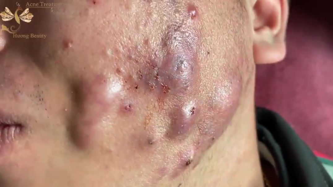 Sensitive! Guinness World Record Largest Pimple Extracted With Suction Cup