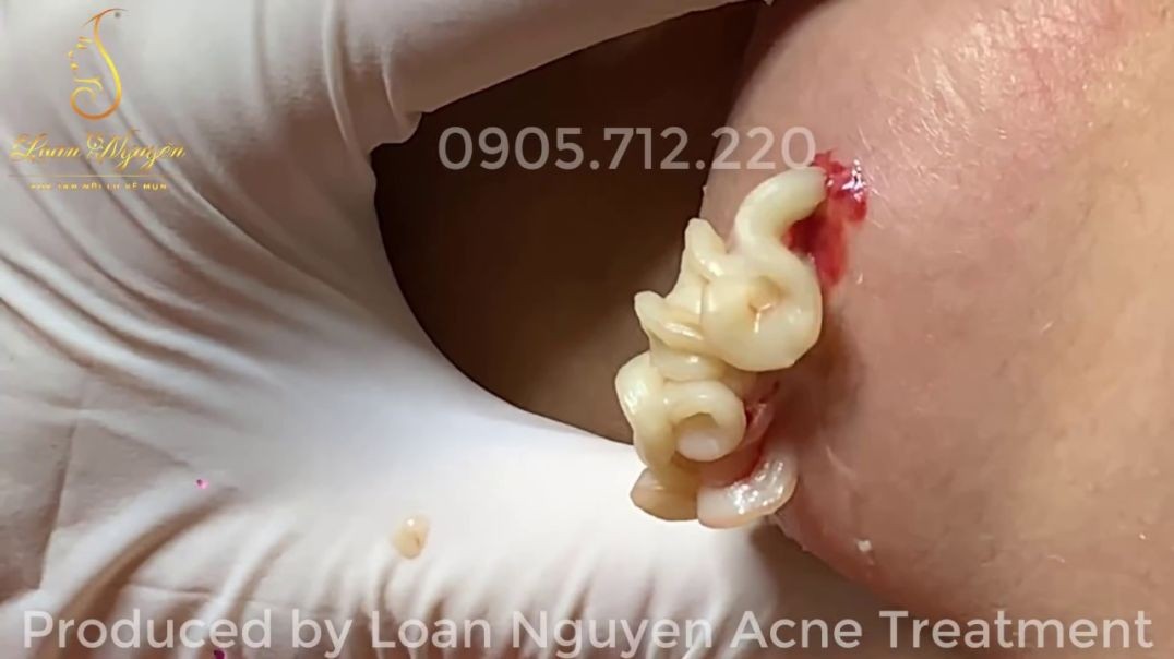Stunning Big Cyst Popping Videos