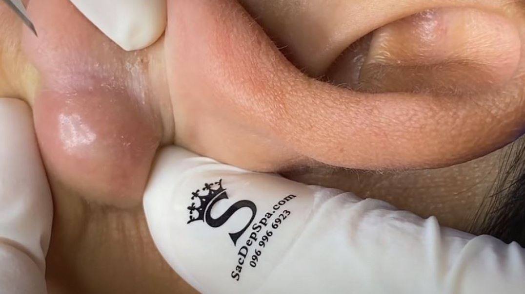 Rare Popping Big Pimples and Cysts Behind the Ear