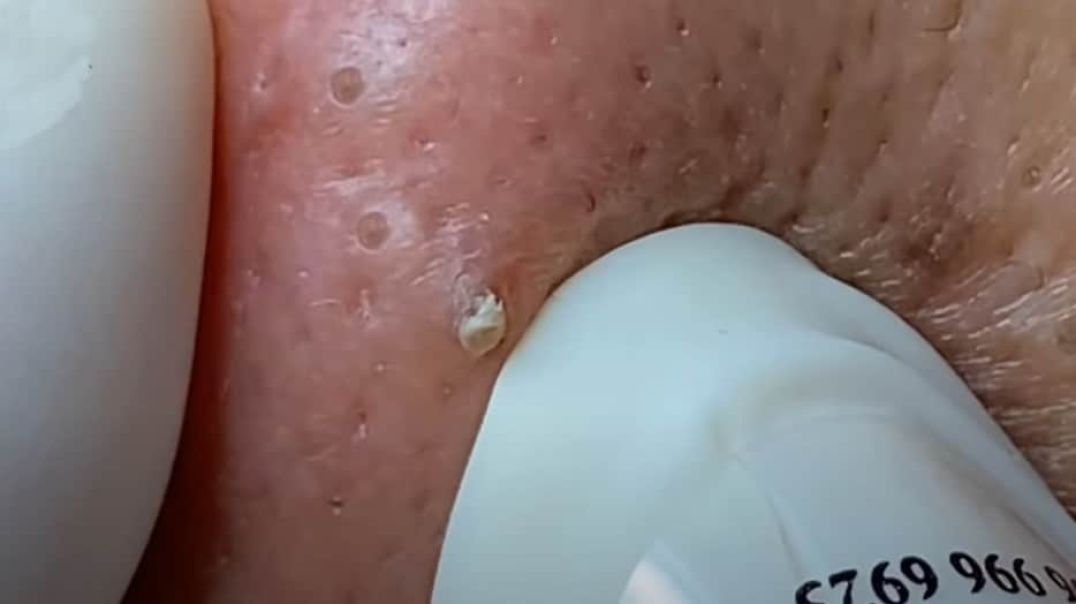 Is Korean Pimple Popping Different