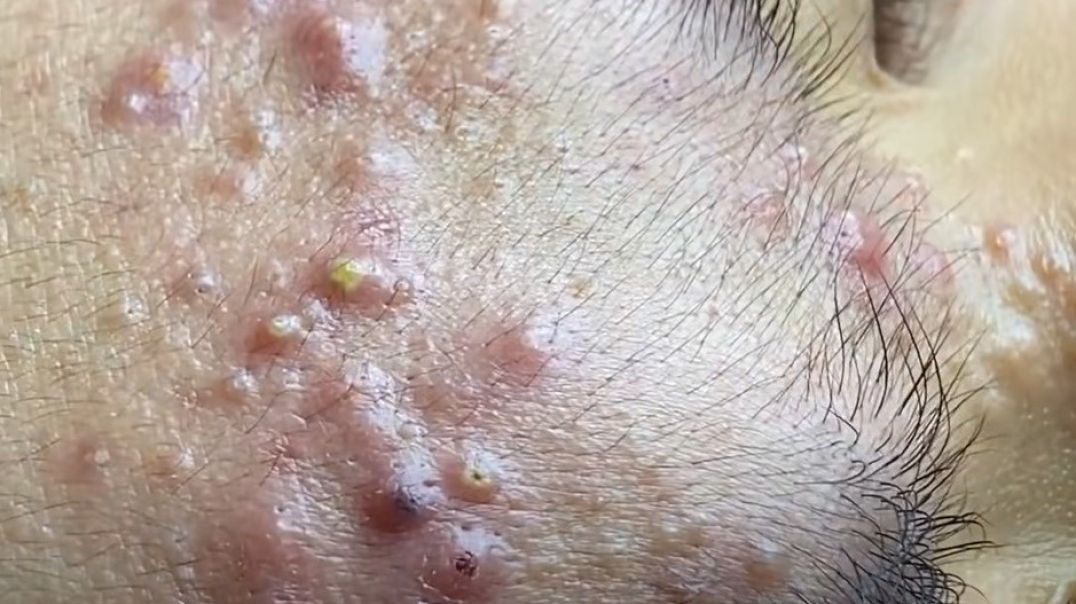 Astonishing Vietnamese Pimple Popping Due to Humid Climate