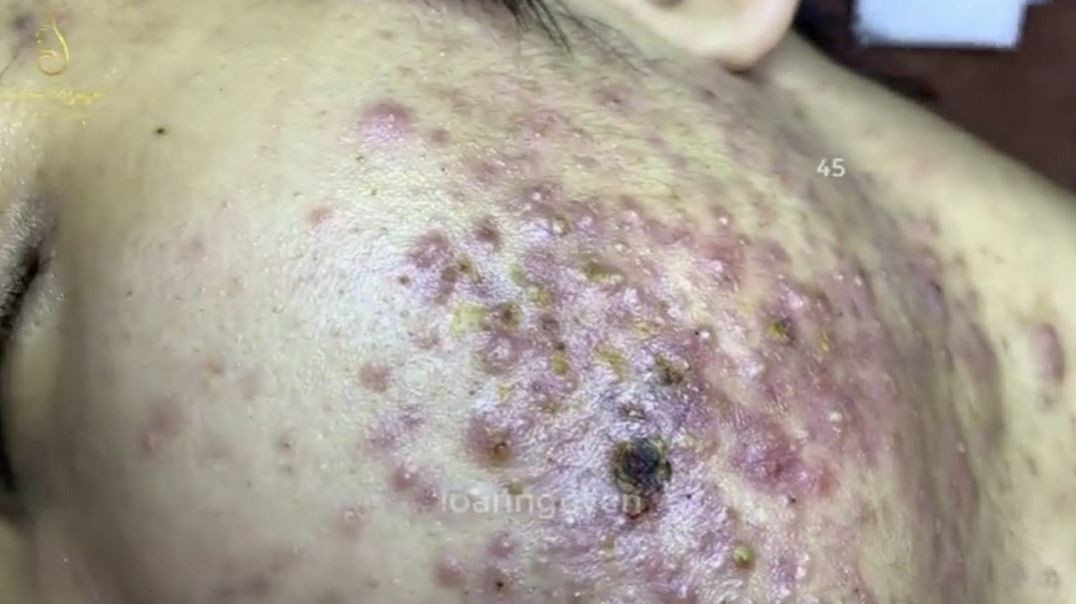 Warning! Inflamed Cystic Acne Removal Videos