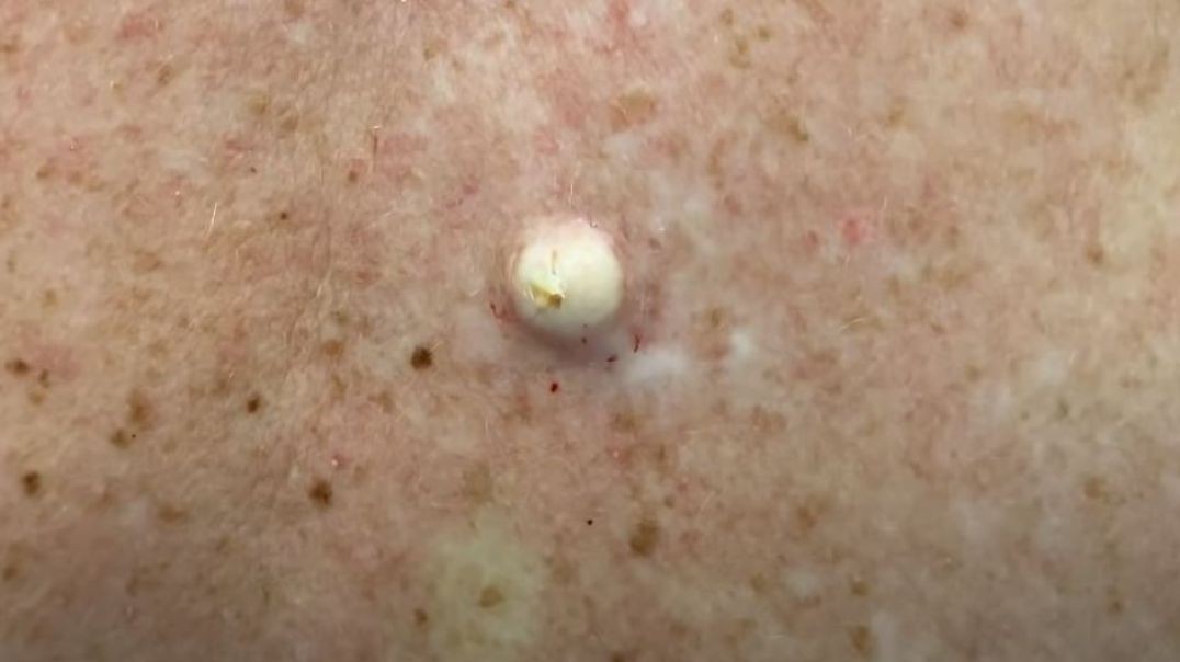 Dr Derm Popping Cysts Compilation
