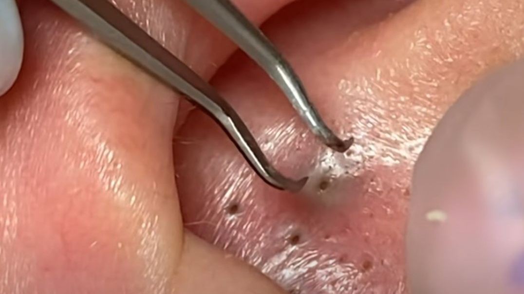 It is so Painful in the EAR (big blackheads)