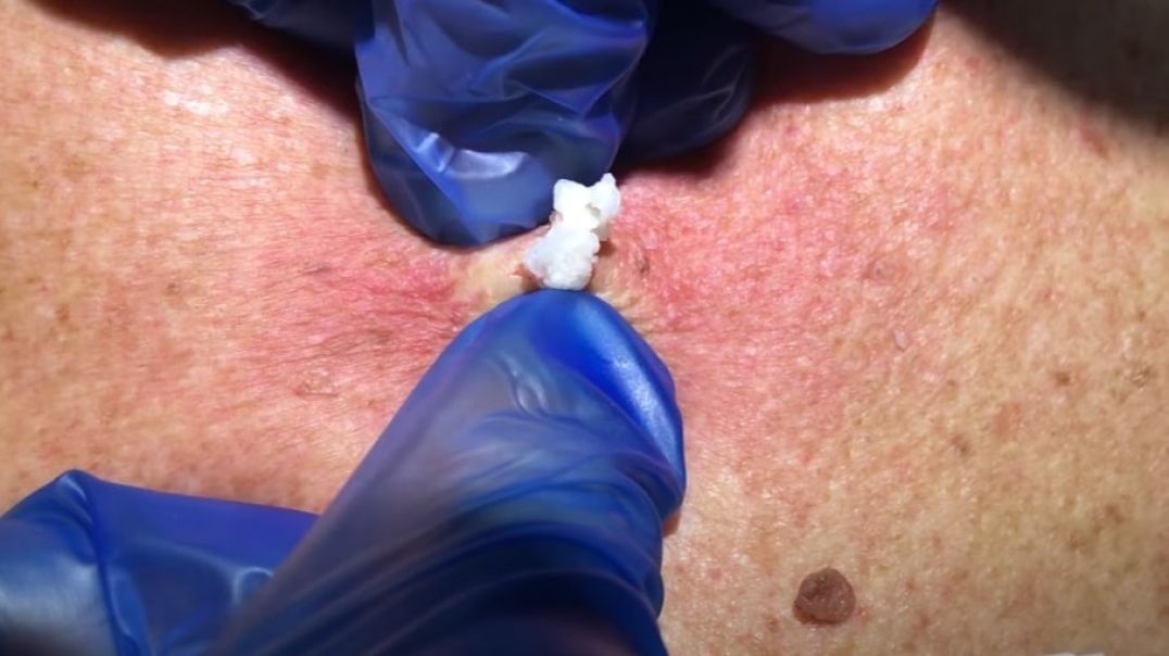 It Is Time to See These New Cyst Popping Videos