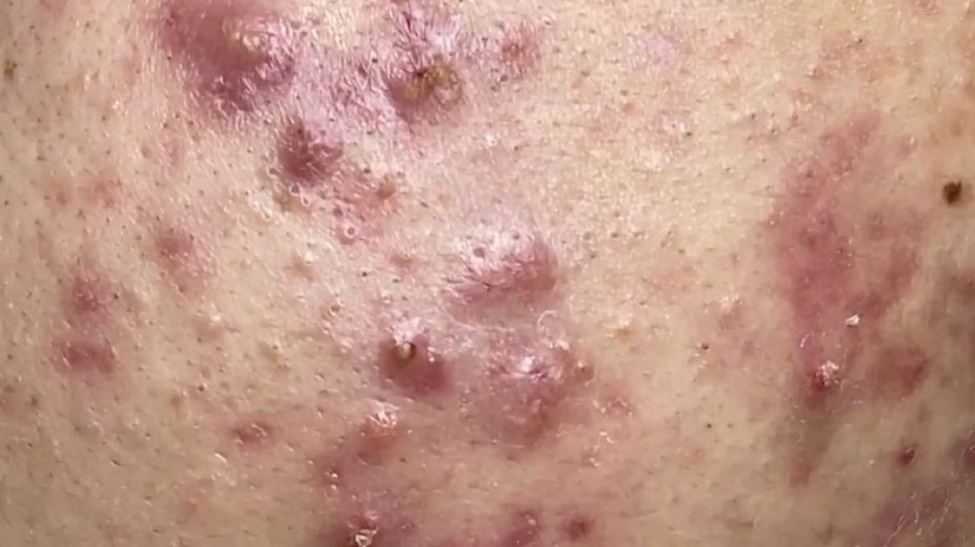 Exciting Cystic Acne Extraction