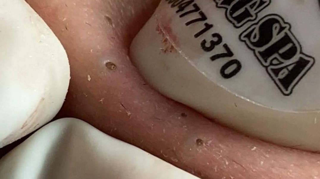 Exclusive Pimple and Blackhead Videos