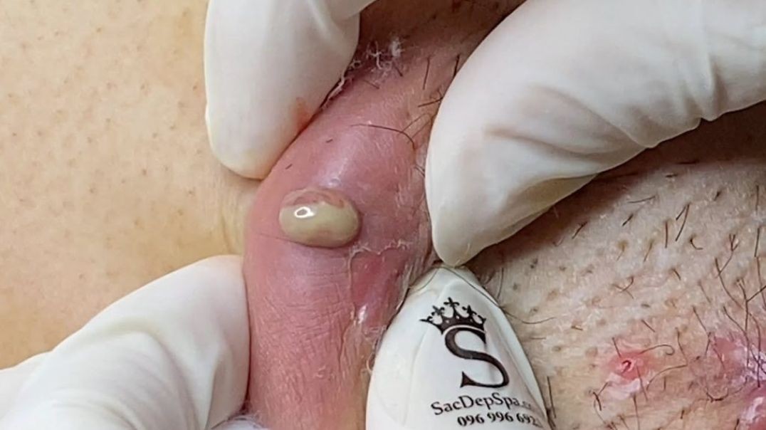 Infected ingrown hair turns into a big cyst popping
