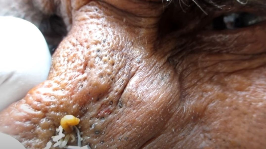 An entire lifetime, whole 55-year-old blackhead