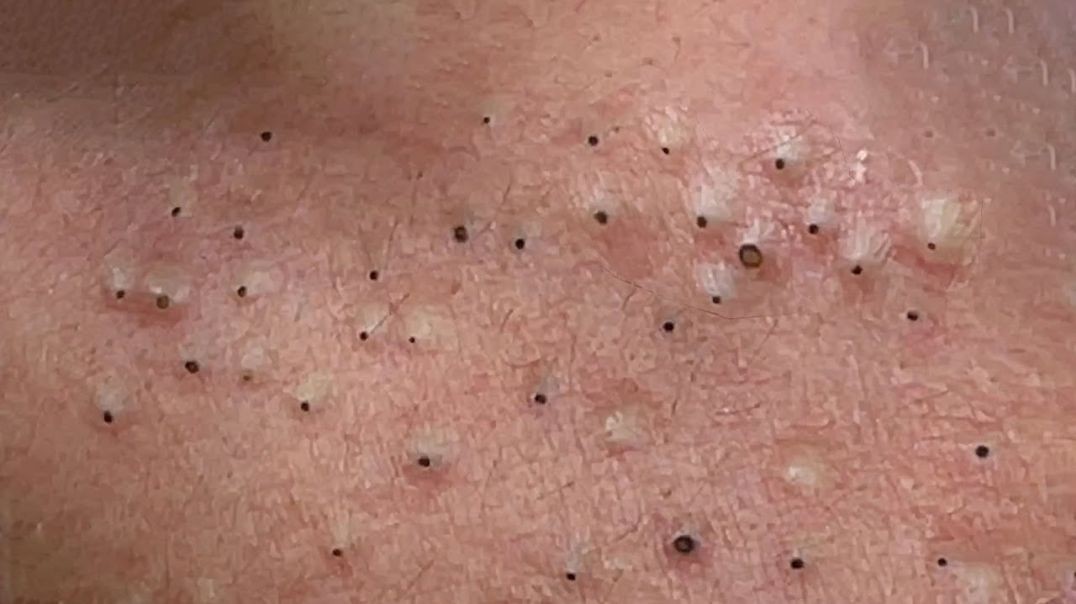 Unusual Popping Huge Blackheads and Pimples