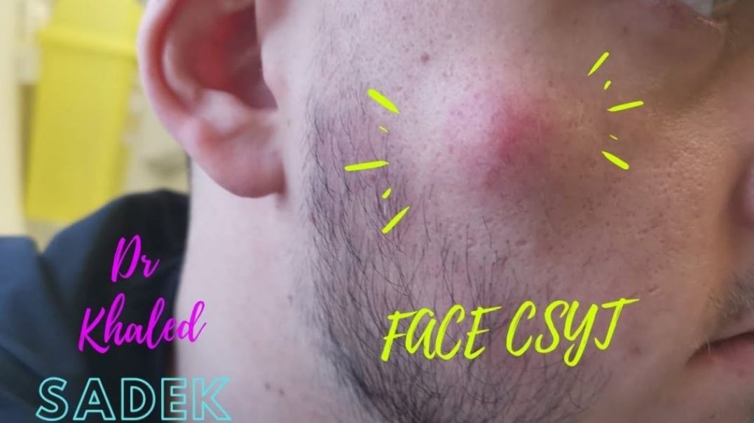 Infinite Sebaceous Cyst Excision