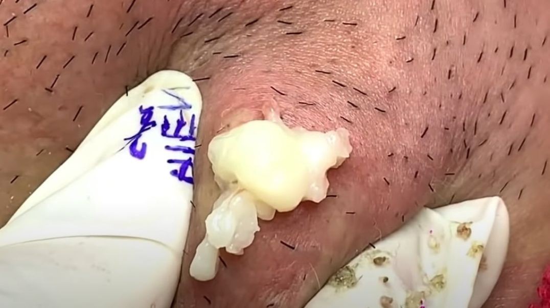 Marvelous Cyst  better than Dr Pimple Popper
