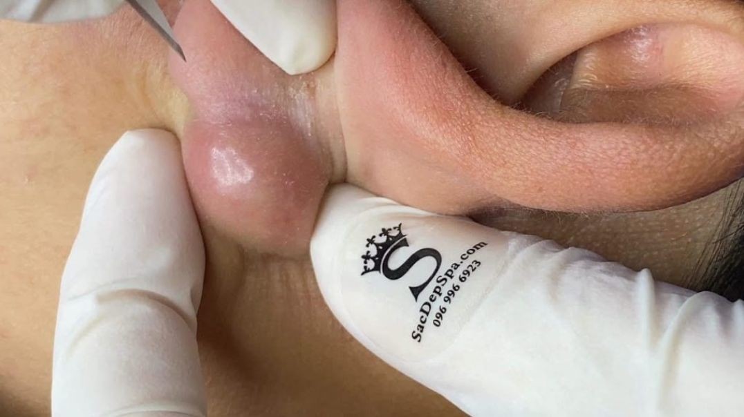 Massive Cyst Extraction Behind the Ear