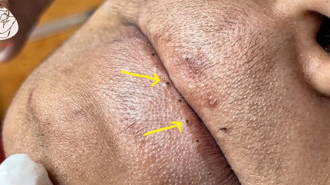 Pimple Popper Blackheads on the Edge of LIPS