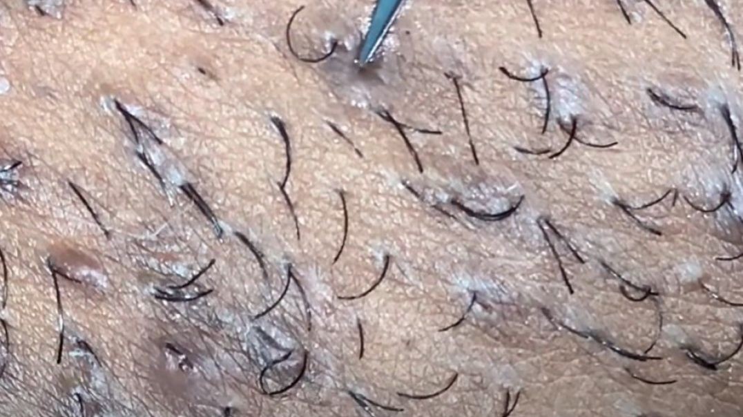 They did it again! Ingrown hair removal videos