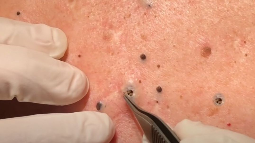You'll Be Shock With the World’s Worst Case of Blackheads