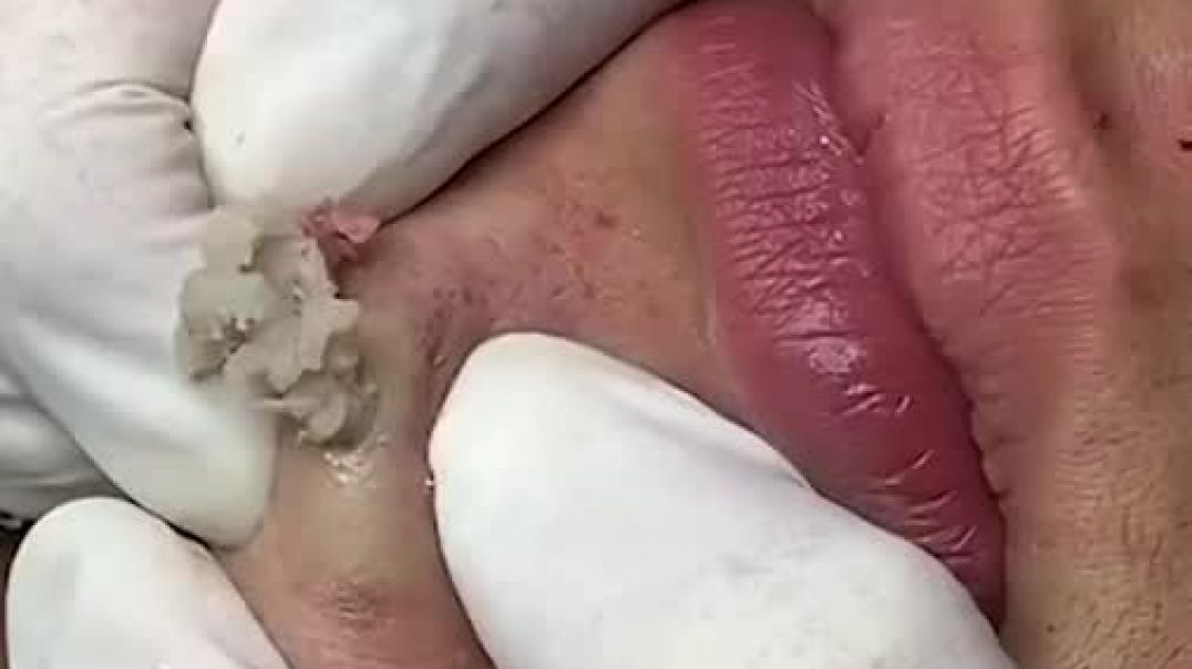 Rare footage! The biggest cyst explosion ever seen on the chin