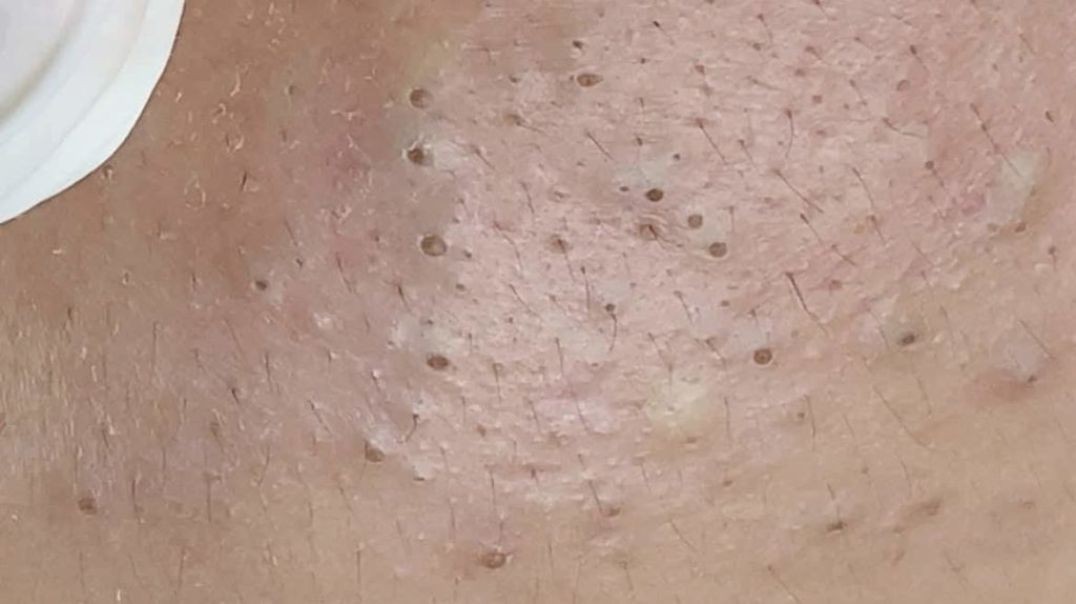 Multiple of Popping Huge Blackheads