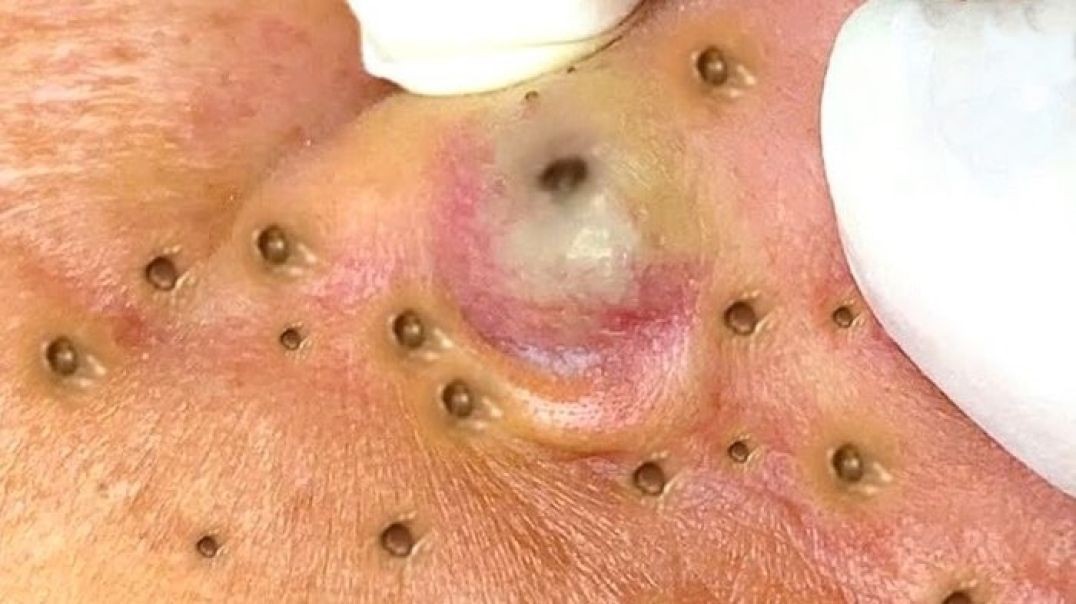 Extreme Close up of Popping Giant Blackheads