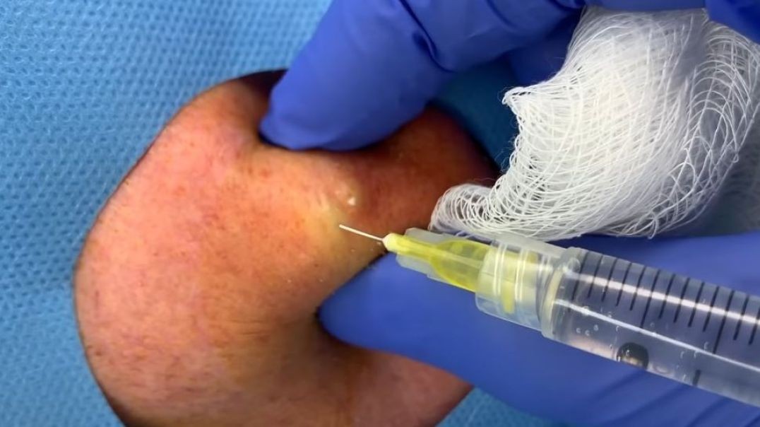 Massive Cyst Pops Under Anesthesia!