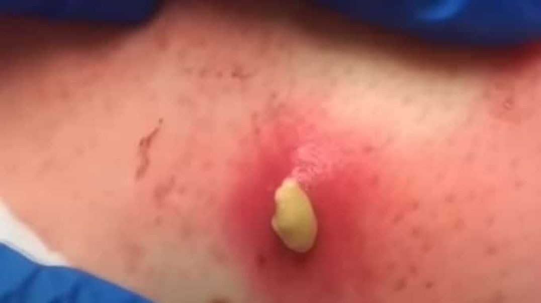 Endless Content from Staph Infection Pus Plug