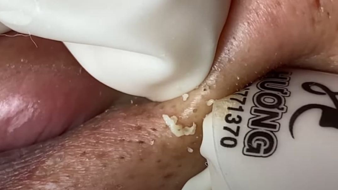 You'll Not Believe Blackhead Squeezing With Fingers
