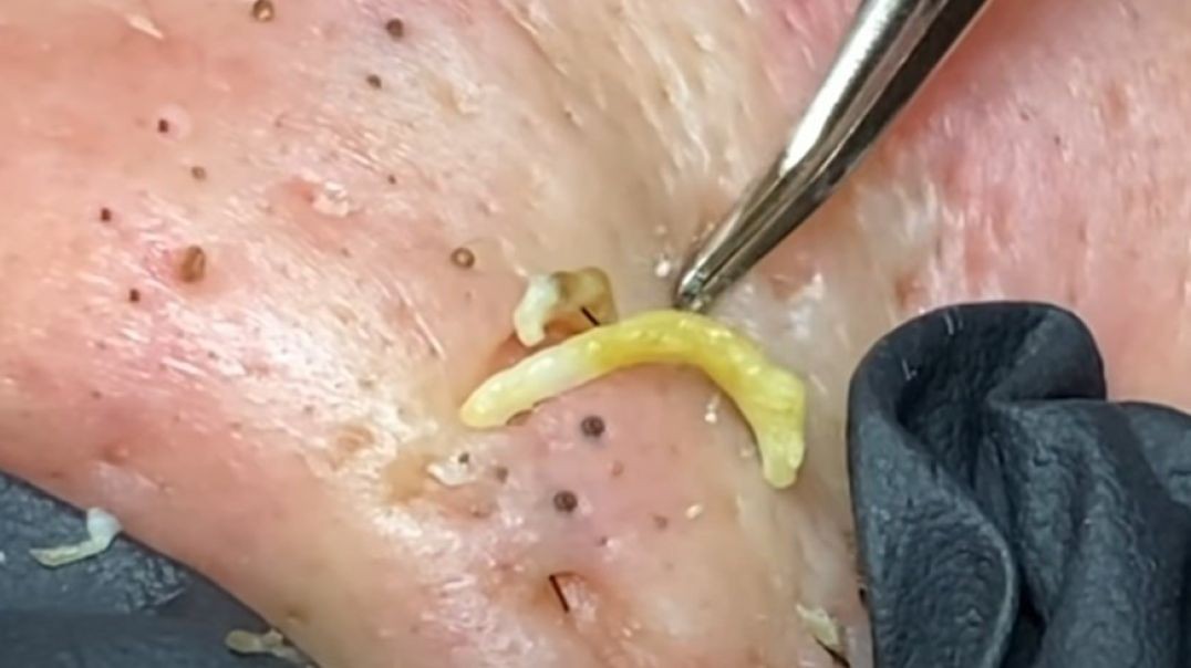 RELAX with these Deep Blackhead Extraction videos