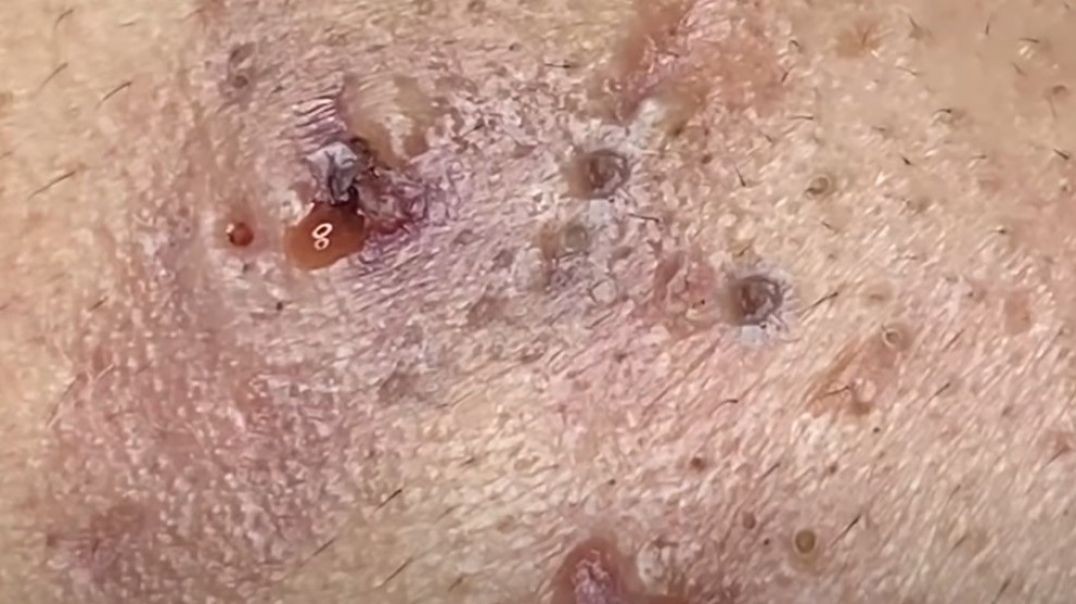 A blackhead popper video that results In, DISASTER