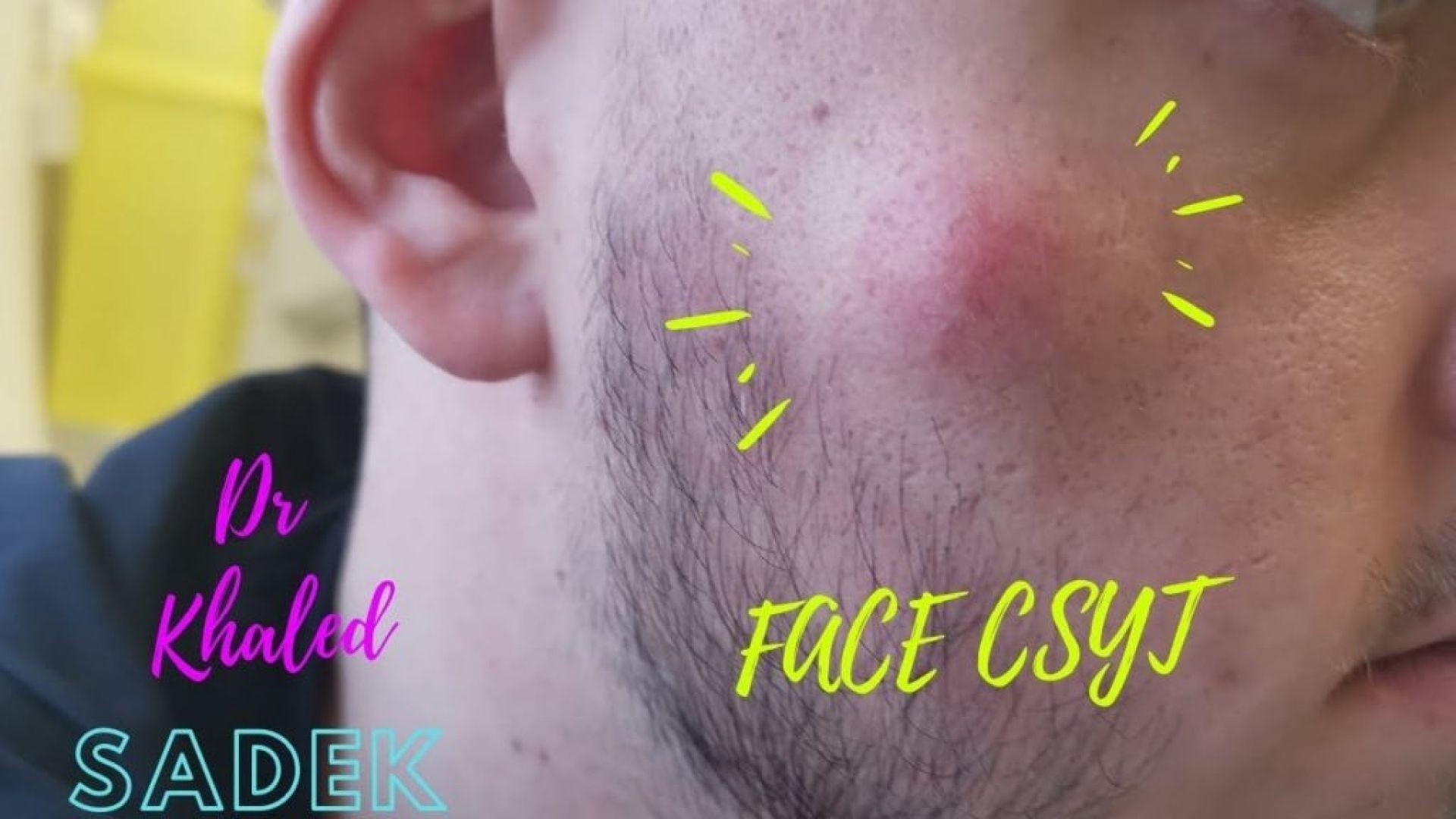 Brand New Cyst Popping Videos 2025