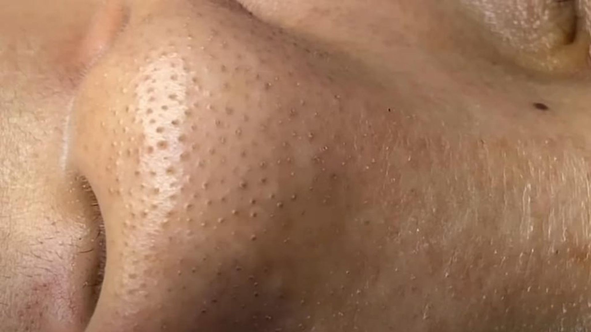 Luckiest Dr. to Extract Popping Blackheads on Nose
