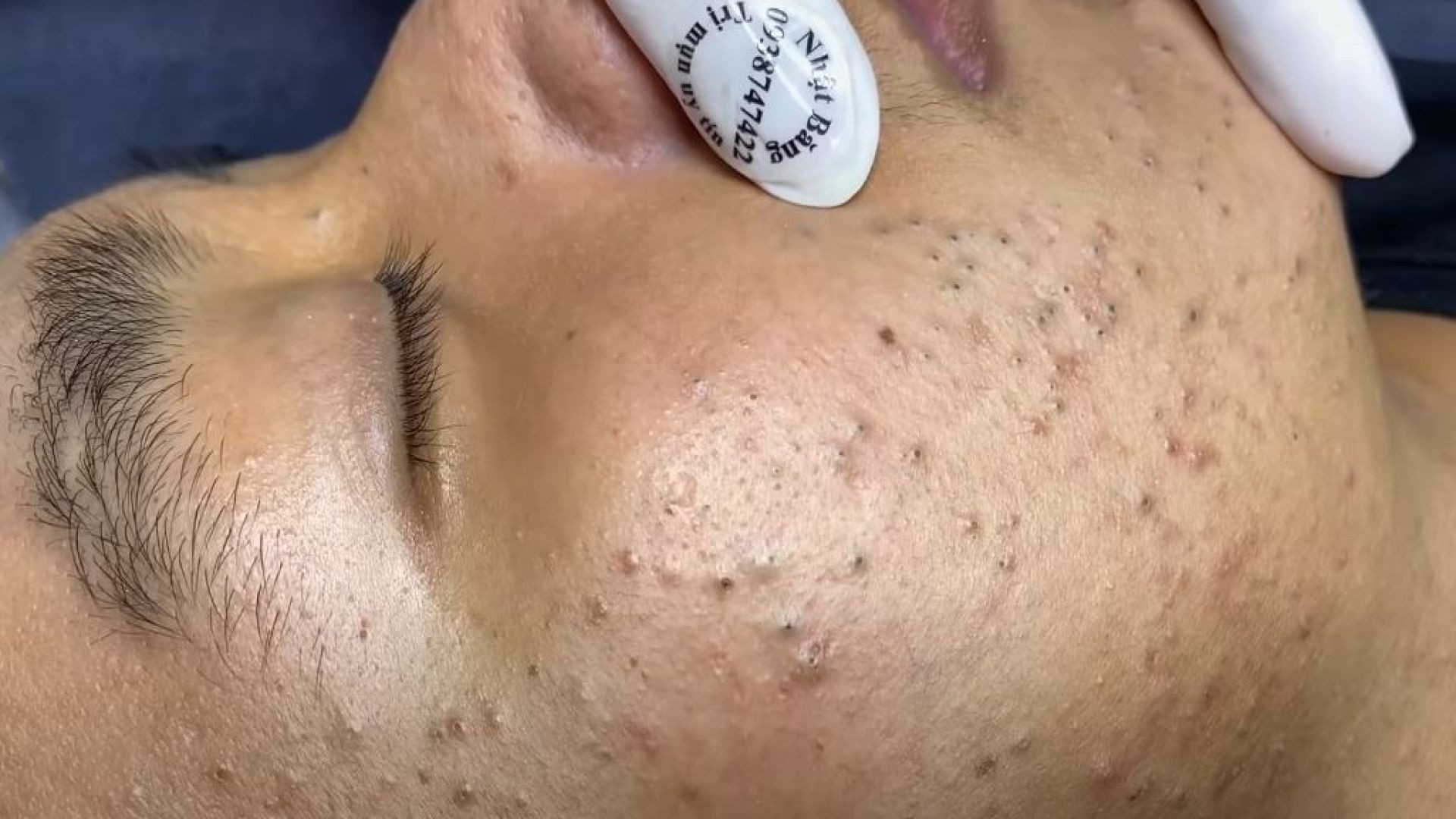 See These Giant Blackheads on the Face