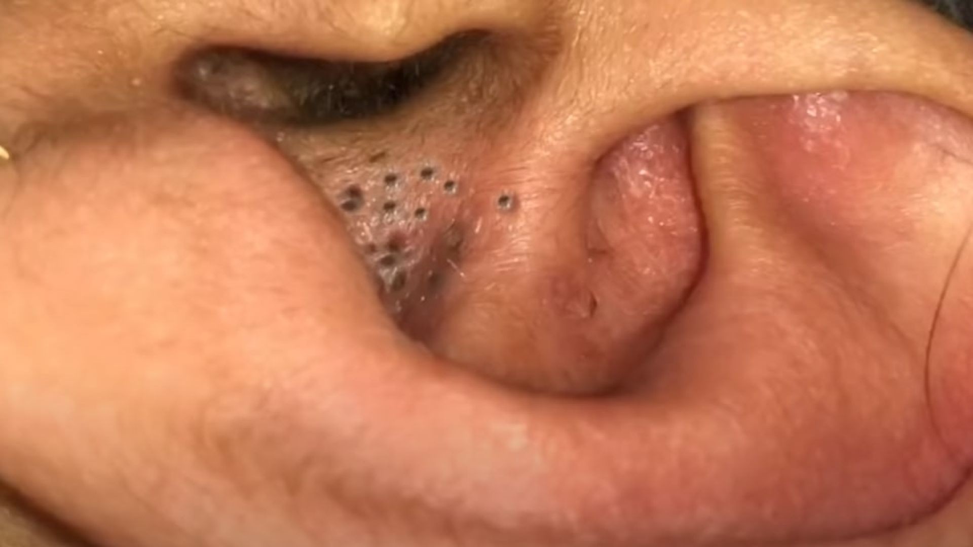 Popping Big Blackheads in ear (What Causes Them?)