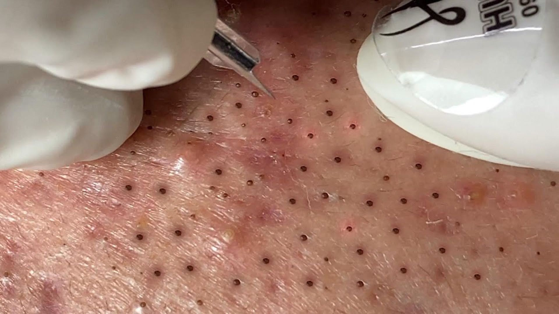 Popping Big Blackheads With Excess Fat