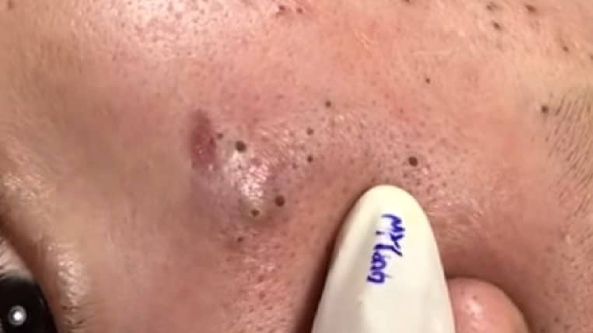 Relax with Loan Spa Blackheads