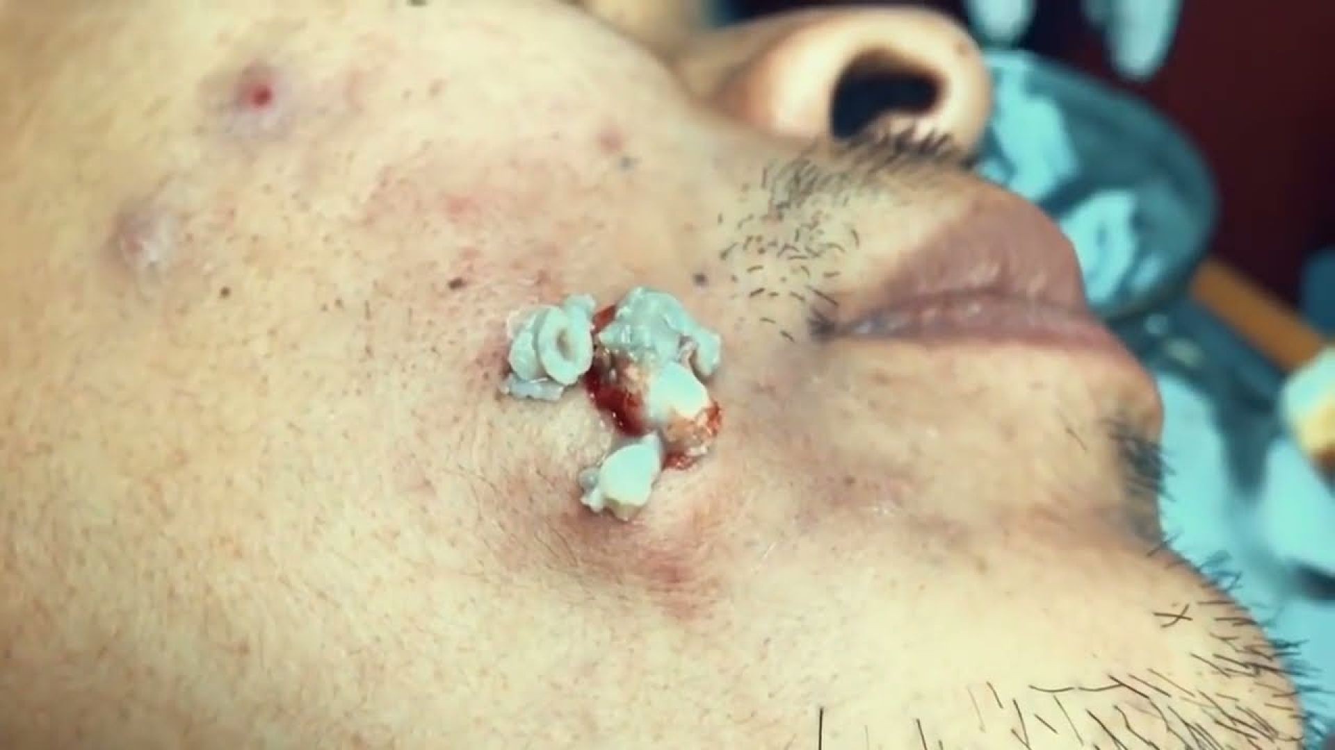 GIGANTIC Facial Brand new Cyst Popping Videos