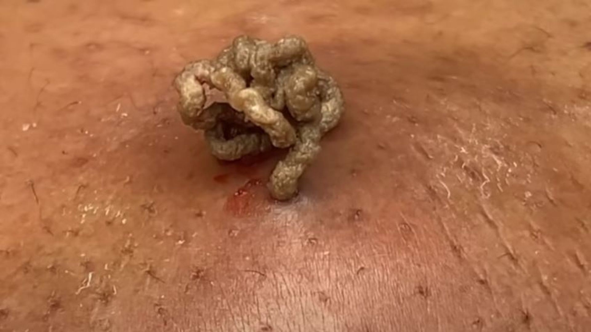 Stop right here for the worst sebaceous cyst ever recorded