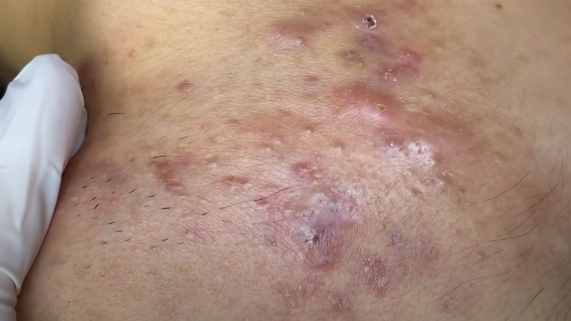 Terrible acne with Chinese pimple popping