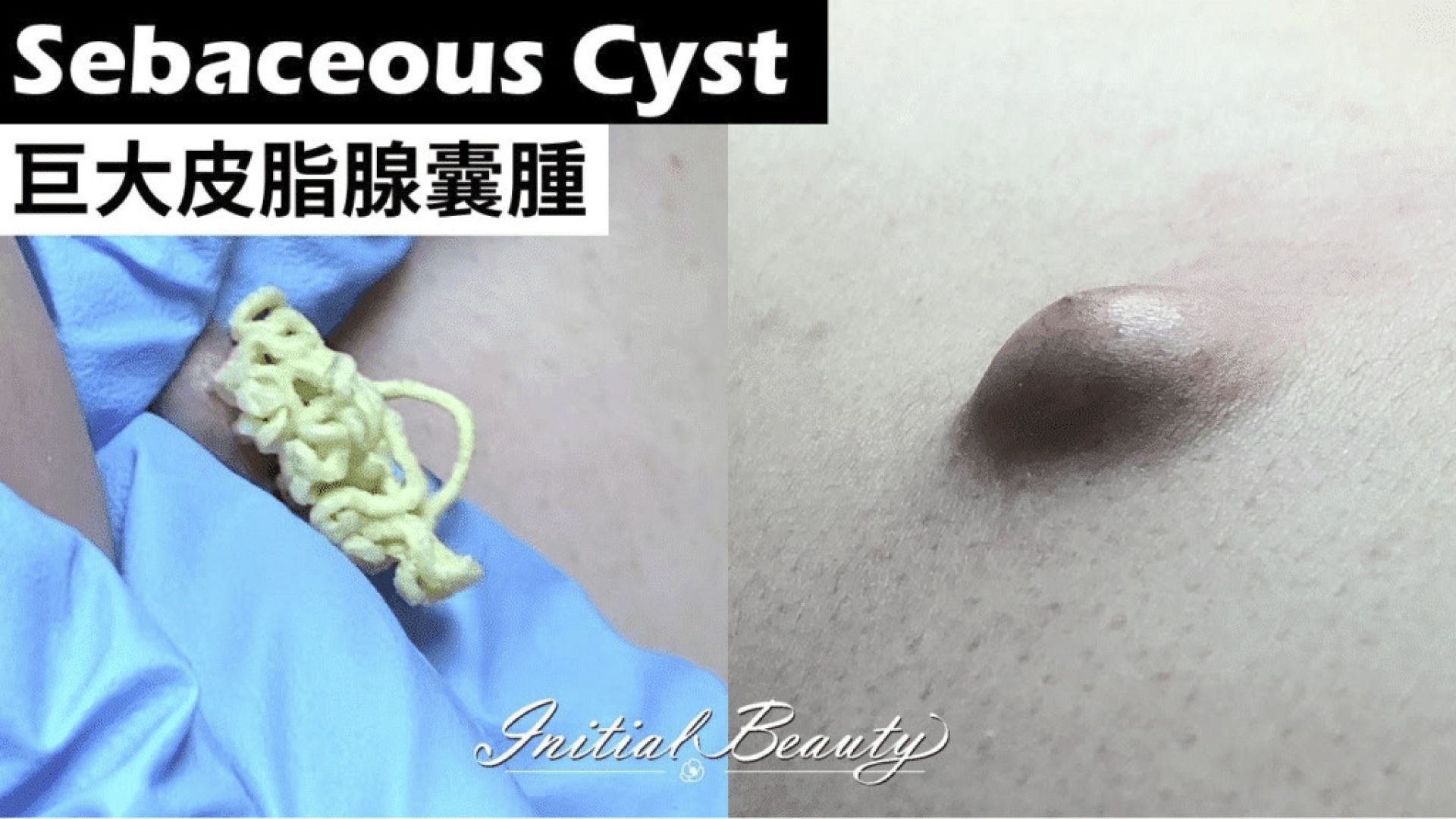 Magnificent Woman’s 20 year old Cyst Bursts