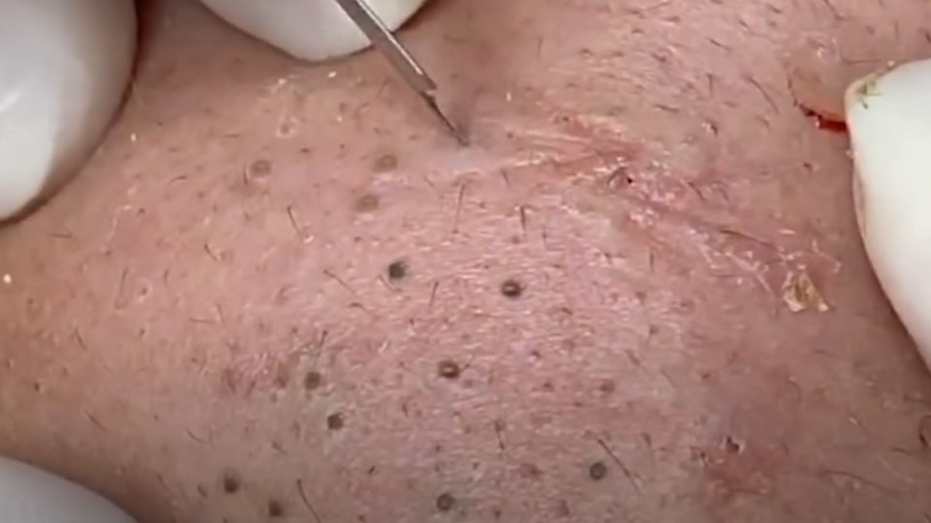 Get to feel this extreme blackhead popping