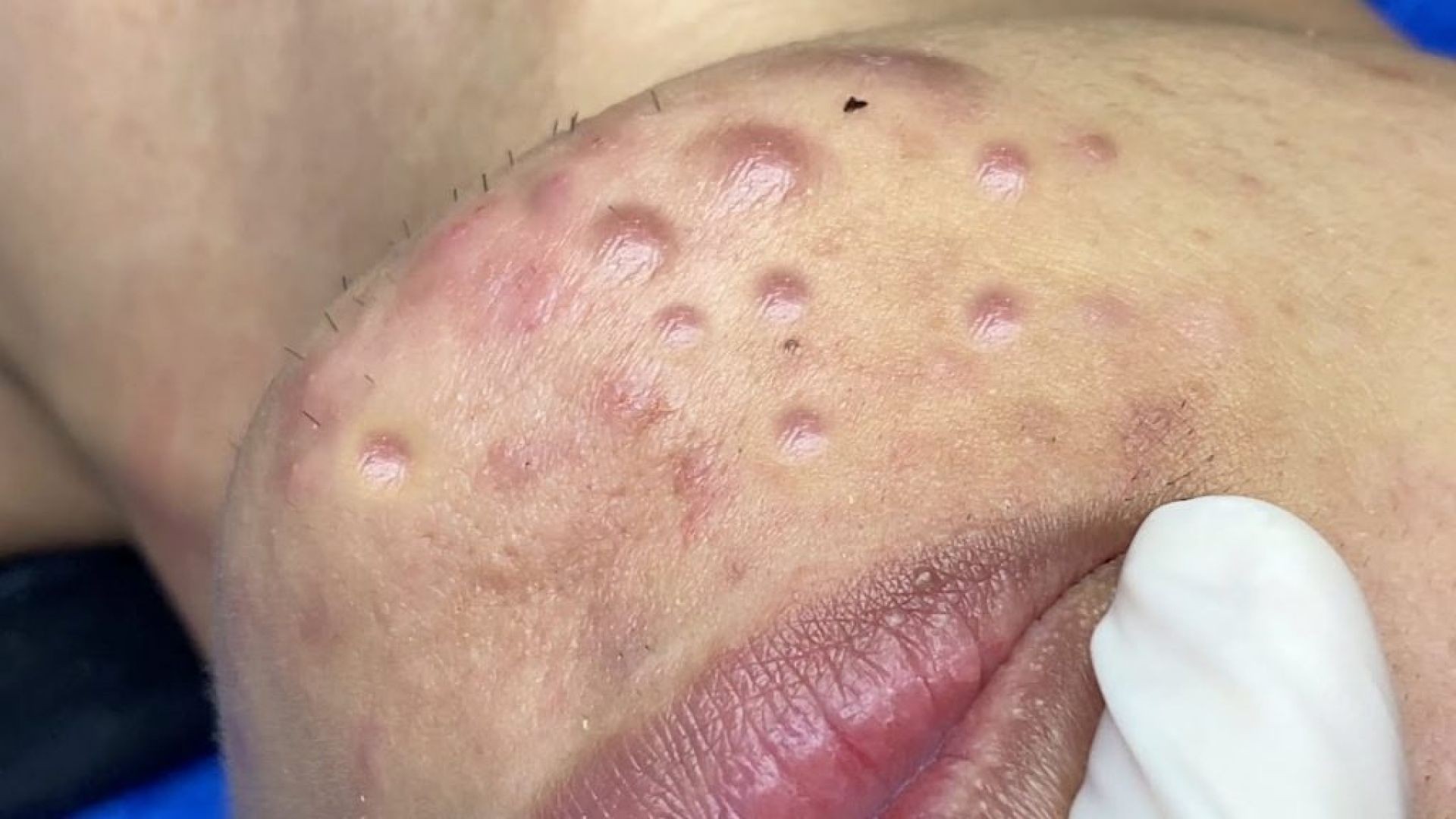 Ugly Yellow Full Screen Pimple Popping Video