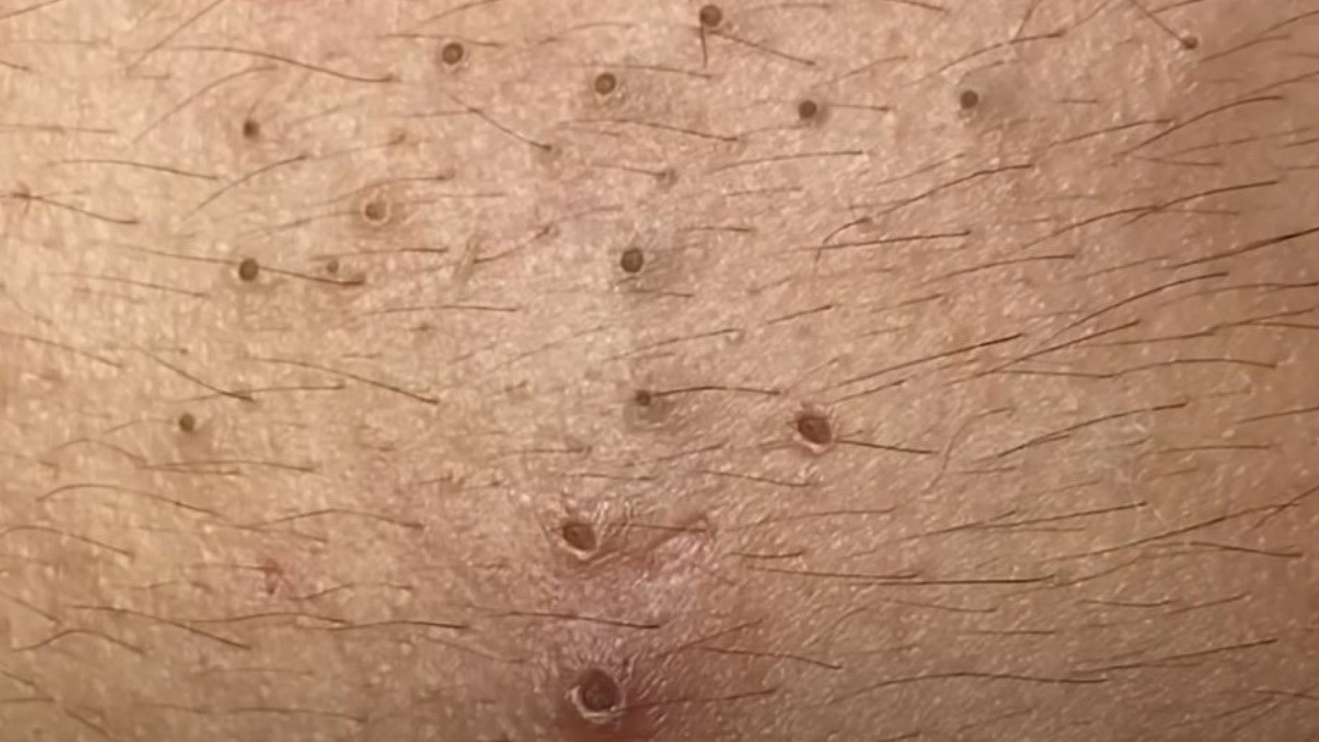 The whole story behind a huge blackhead removal