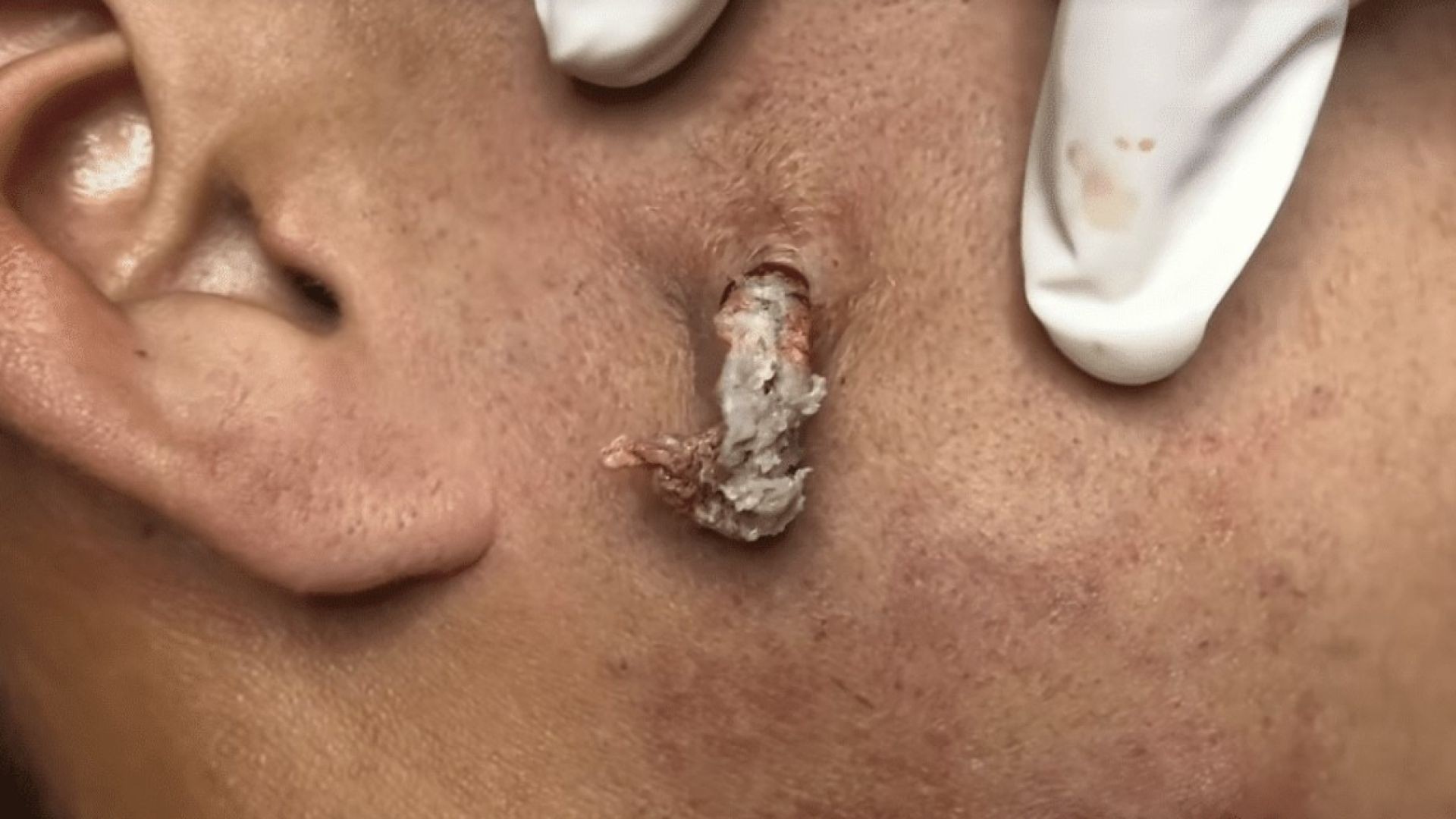 Amusing and Pleasant Cyst Explosion