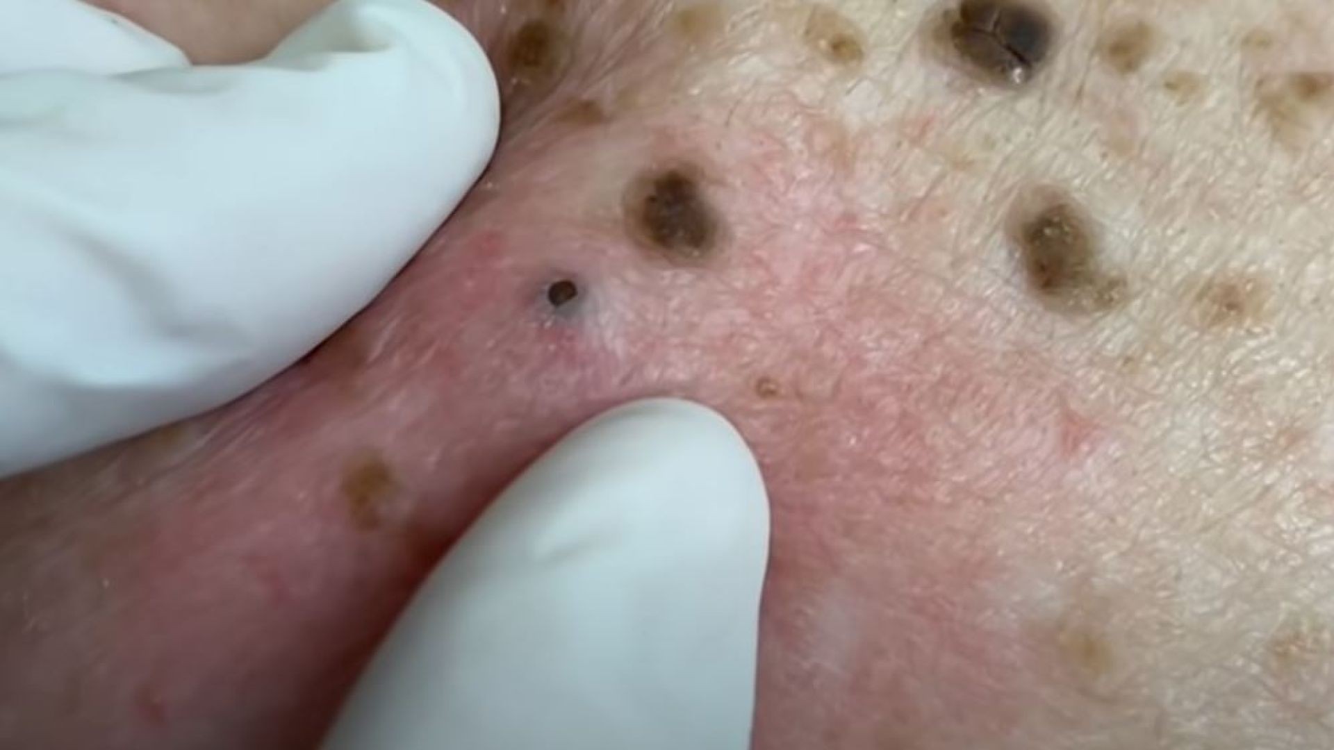 Pimple Popper Cysts Like SHARK Tooth