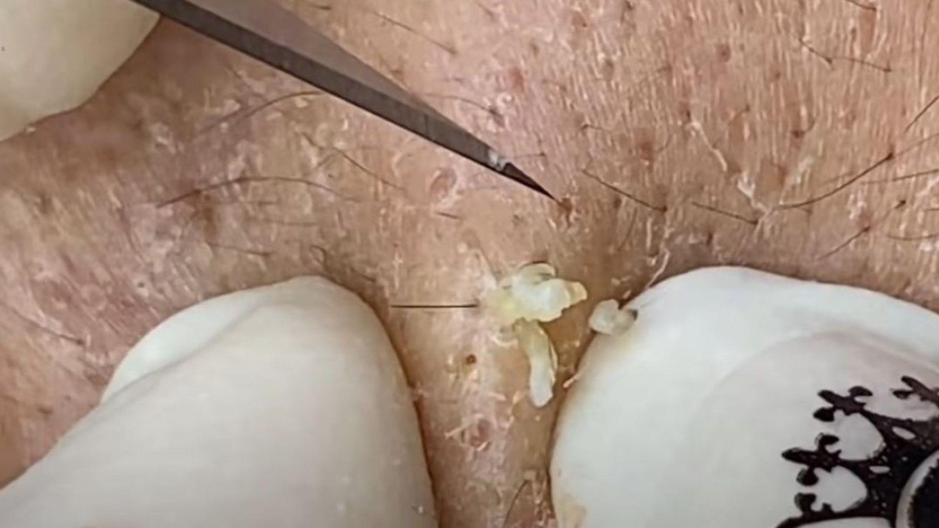 Get satisfied with the biggest pimple ever popped