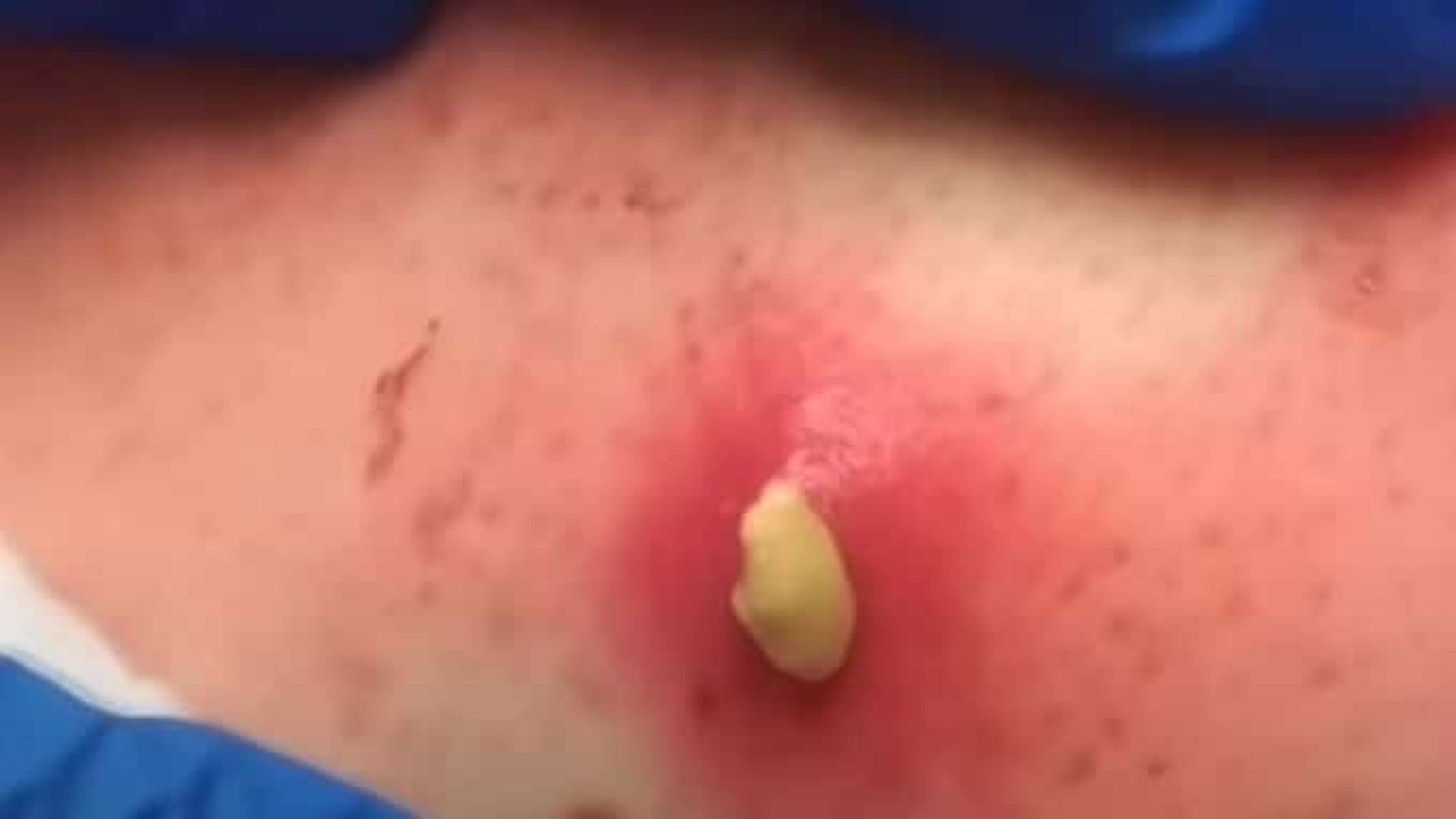 Endless Content from Pus Plug Infection