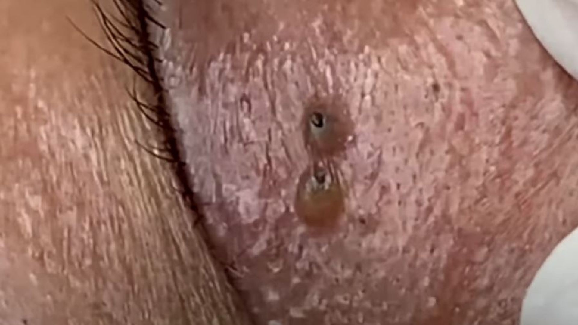 Reduce ANXIETY with Unbelievable Blackhead Removal