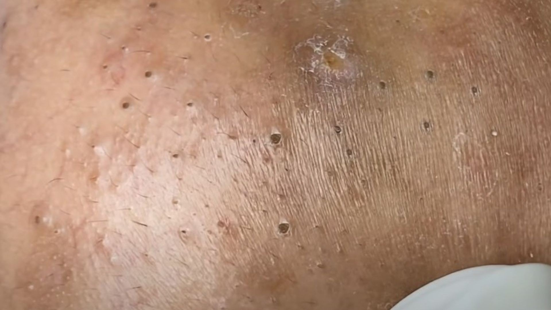 New pimple popping of the last stage of severe acne