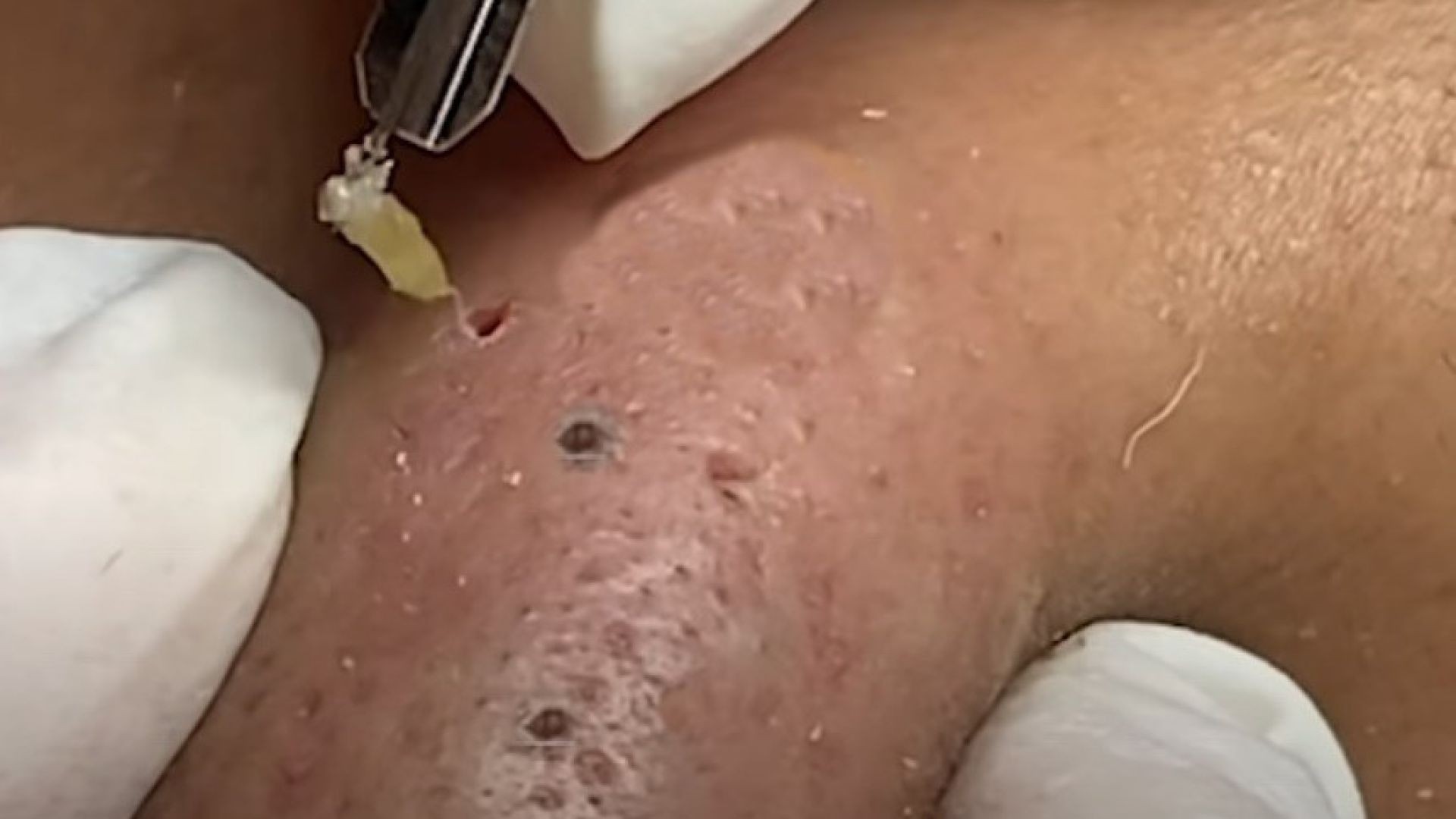 Get SATISFIED with these squeezing big blackheads