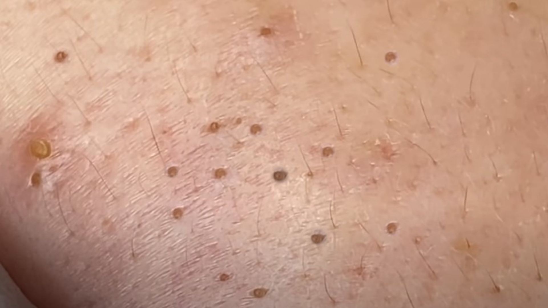 These blackheads up close bring so much satisfaction