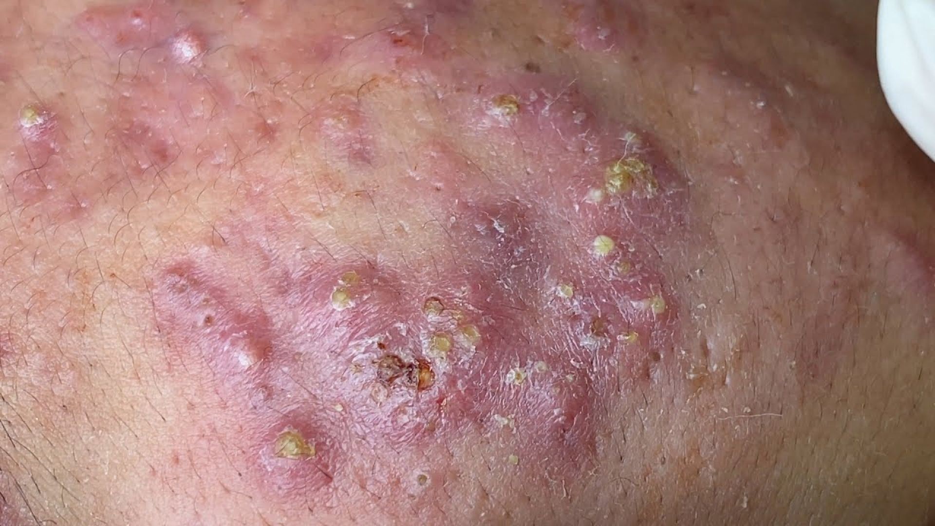 Relax with Massive Cystic Acne Popping Video